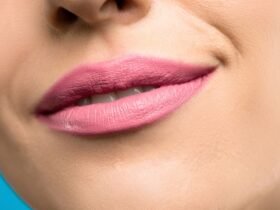 Cupid Lip Lift Los Angeles #beverlyhillsmagazine #beverlyhills #liplift #cupidlips #bentalei #lipsurgery
