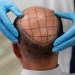 Thinking Of A Hair Transplant? Here Are Things To Consider