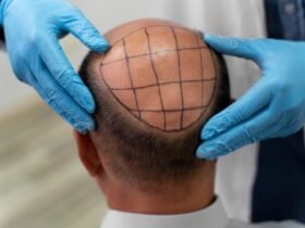 Thinking Of A Hair Transplant? Here Are Things To Consider