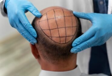Thinking Of A Hair Transplant? Here Are Things To Consider