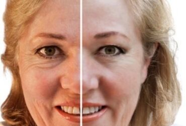 A Detailed Guide About Facelift Surgeries #beverlyhills #beverlyhillsmagazine #bevhillsmag #faceliftsurgery #cosmeticsurgery #plasticsurgery