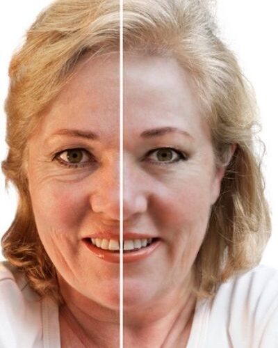 A Detailed Guide About Facelift Surgeries #beverlyhills #beverlyhillsmagazine #bevhillsmag #faceliftsurgery #cosmeticsurgery #plasticsurgery