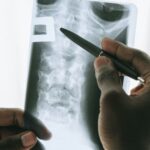 Can Stem Cells Be The Cure For Pulmonary Fibrosis? #beverlyhills #beverlyhillsmagazine #stemcells #pulmonaryfibrosis #fatallungdisease #stemcelltherapy #lungtransplant #bevhillsmag