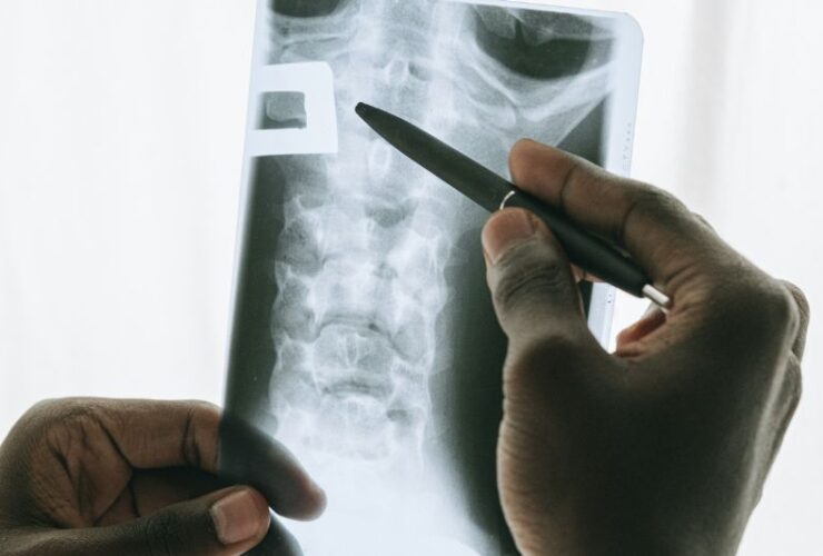 Can Stem Cells Be The Cure For Pulmonary Fibrosis? #beverlyhills #beverlyhillsmagazine #stemcells #pulmonaryfibrosis #fatallungdisease #stemcelltherapy #lungtransplant #bevhillsmag