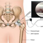 Hip Arthroscopy Specialists: Innovative Solutions for Hip Conditions #beverlyhills #beverlyhillsmagazine #hipproblems #arthroscopyspecialist #surgicalinnovations #physicaltherapy