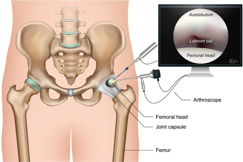 Hip Arthroscopy Specialists: Innovative Solutions for Hip Conditions #beverlyhills #beverlyhillsmagazine #hipproblems #arthroscopyspecialist #surgicalinnovations #physicaltherapy