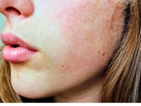 Home Remedies to Reduce Face Swelling! #beverlyhills #beverlyhillsmagazine #faceinflammation #faceswelling #puffyface #lackofsleep #unhealthyhabits