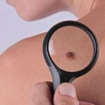 How To Remove Skin Tags With Natural Treatment #skin #skintags #moles #health #beverlyhills #beverlyhillsmagazine #bevhillsmag