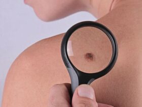 How To Remove Skin Tags With Natural Treatment #skin #skintags #moles #health #beverlyhills #beverlyhillsmagazine #bevhillsmag