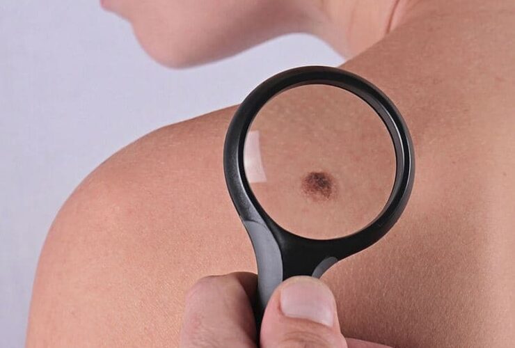 How To Remove Skin Tags With Natural Treatment #skin #skintags #moles #health #beverlyhills #beverlyhillsmagazine #bevhillsmag