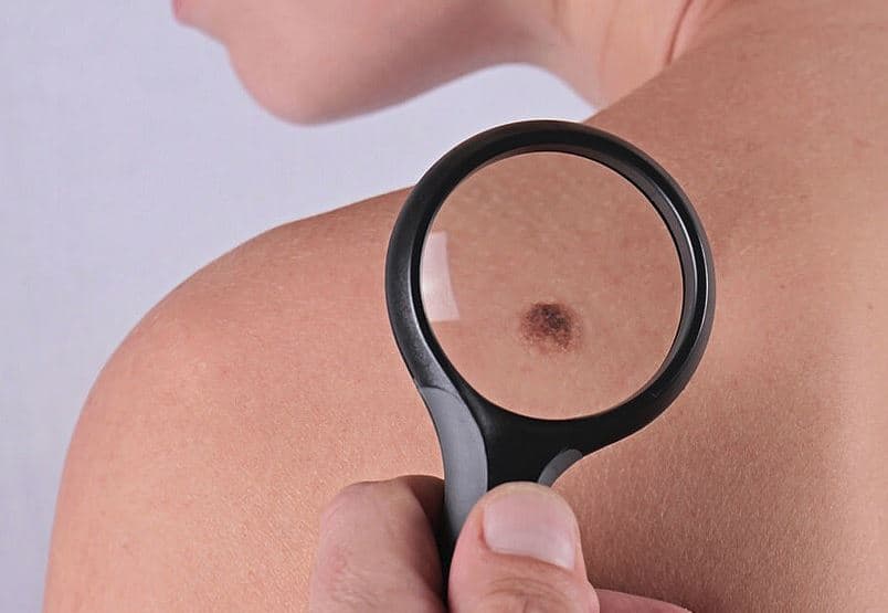 How To Remove Skin Tags With Natural Treatment #skin #skintags #moles #health #beverlyhills #beverlyhillsmagazine #bevhillsmag