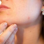 How to Keep Your Face Acne Free #SkinHealth #AcneFree #HealthySkin #Wellness #SelfCare