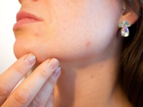 How to Keep Your Face Acne Free #SkinHealth #AcneFree #HealthySkin #Wellness #SelfCare