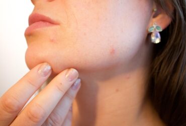 How to Keep Your Face Acne Free #SkinHealth #AcneFree #HealthySkin #Wellness #SelfCare