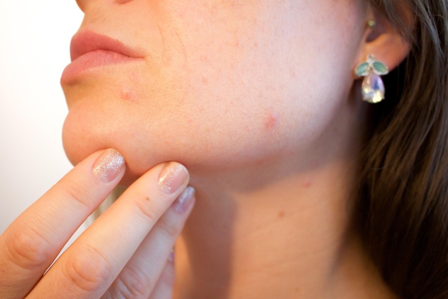 How to Keep Your Face Acne Free #SkinHealth #AcneFree #HealthySkin #Wellness #SelfCare