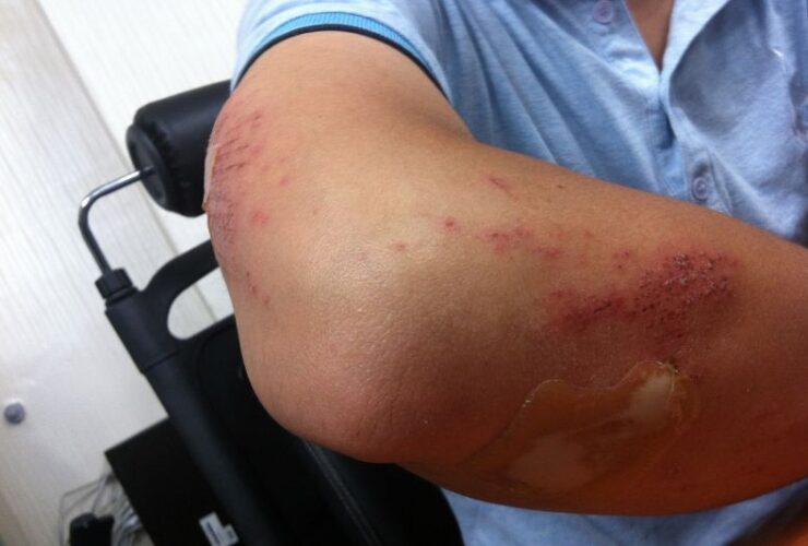 Injured on a Business Trip? Here’s What You Must Do #beverlyhills #beverlyhillsmagazine #businesstrip #personalinjurylawyer #medicalattention #personalinjurylawsuit