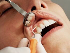 Most Common Dental Procedures in Hollywood #beverlyhills #beverlyhillsmagazine #bevhillsmag #dentalprocedure #beverlyhillscelebrities #dentist #bevhillsmag