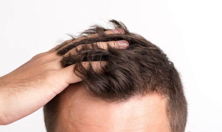 What To Do When Your Hair Starts Thinning #hair #hairthinning #hairloss #beauty #grooming