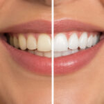 How to Keep Your Teeth Healthier #health #beauty #smile #teeth #beverlyhills #bevhillsmag #beverlyhillsmagazine