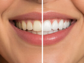 How to Keep Your Teeth Healthier #health #beauty #smile #teeth #beverlyhills #bevhillsmag #beverlyhillsmagazine