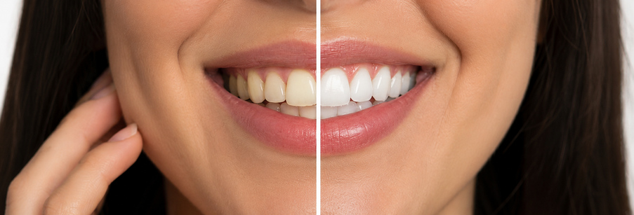 How to Keep Your Teeth Healthier #health #beauty #smile #teeth #beverlyhills #bevhillsmag #beverlyhillsmagazine