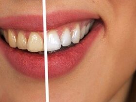 How to Keep Your Teeth Healthier #health #beauty #smile #teeth #beverlyhills #bevhillsmag #beverlyhillsmagazine