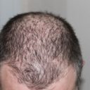 LLLT vs Hair Transplants for Hair Loss #hair #beauty #beverlyhills #bevhillsmag