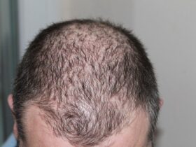 LLLT vs Hair Transplants for Hair Loss #hair #beauty #beverlyhills #bevhillsmag