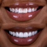 Glamorous woman with a radiant, natural smile — porcelain veneers by Dr. Chirag Patel, Smilesbydrp, Beverly Hills