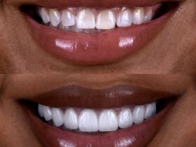 Glamorous woman with a radiant, natural smile — porcelain veneers by Dr. Chirag Patel, Smiles by Dr. P, Beverly Hills