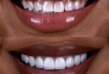 Glamorous woman with a radiant, natural smile — porcelain veneers by Dr. Chirag Patel, Smilesbydrp, Beverly Hills
