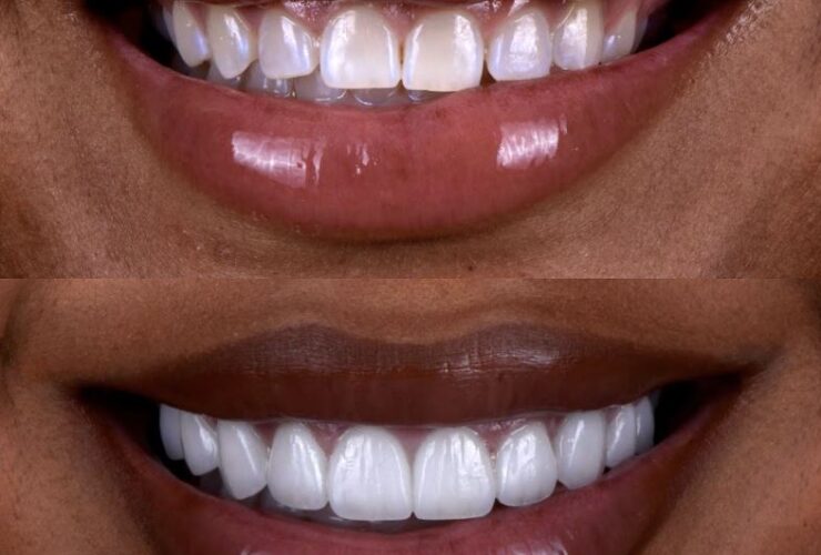 Glamorous woman with a radiant, natural smile — porcelain veneers by Dr. Chirag Patel, Smilesbydrp, Beverly Hills