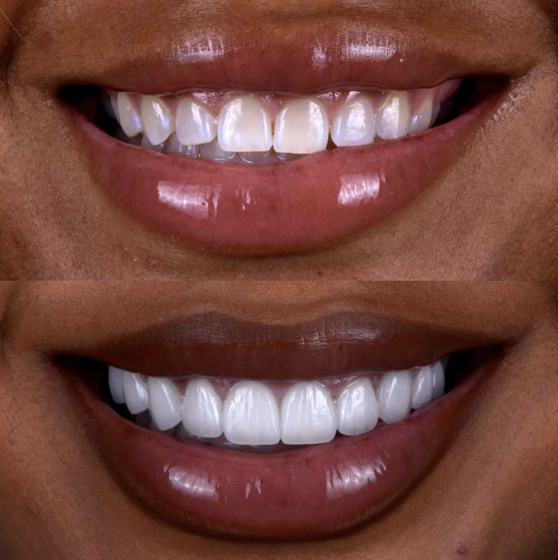 Glamorous woman with a radiant, natural smile — porcelain veneers by Dr. Chirag Patel, Smilesbydrp, Beverly Hills